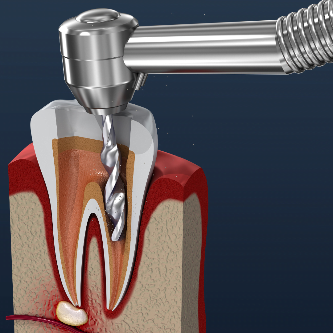 Painless Root Canal Treatment In Gurgaon Mahavirai Dental And Medical