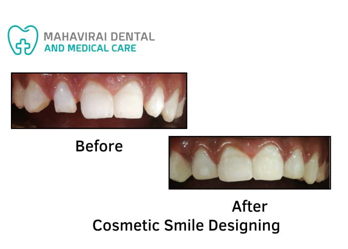 Cosmetic Smile Designing