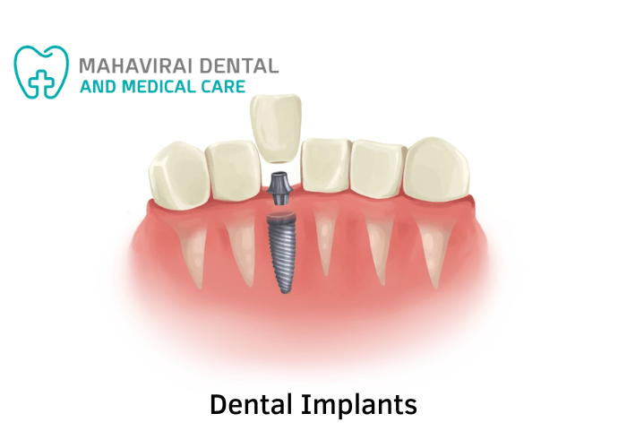 dental implants