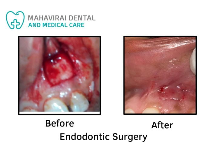 Endodontic Surgery