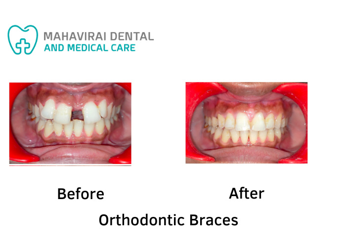 orthodontic braces