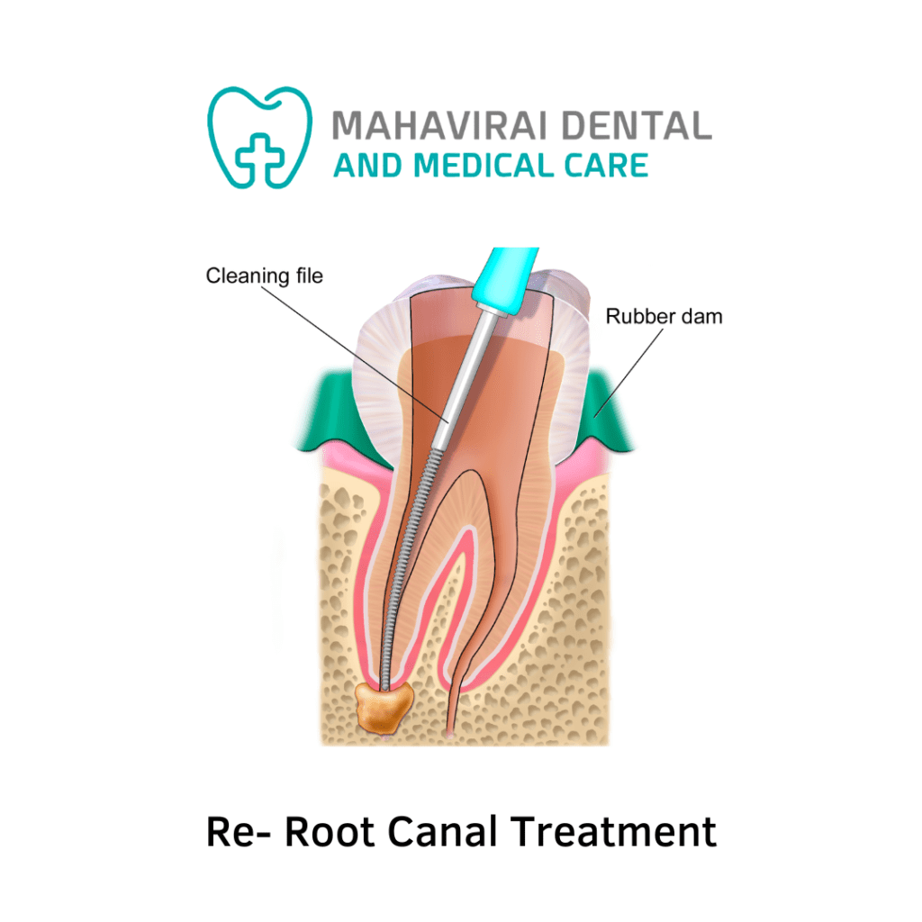 Re Rct at Mahavirai Dental, Gurgaon; Best Dentist in Gurgaon