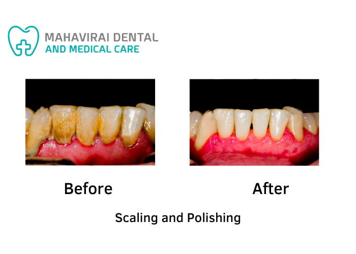 Scaling and Polishing