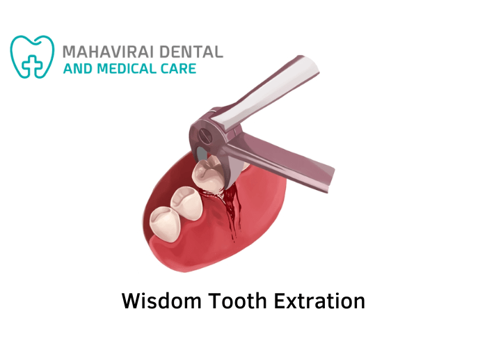 Wisdom Tooth Extraction