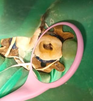 painless root canal treatment