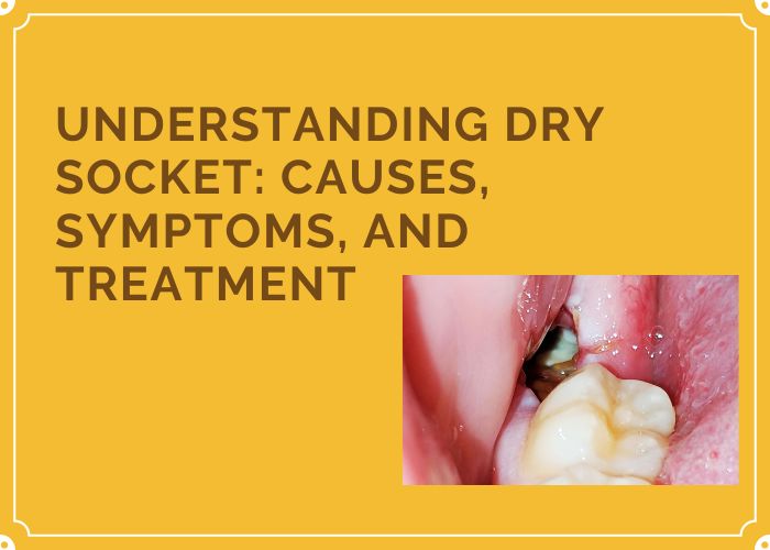 dental dry sockets treatment in gurgaon