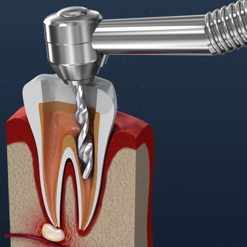 painless-root-canal